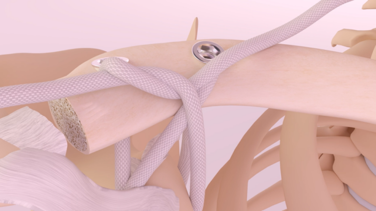 Movmedix LARS Acromioclavicular 3D